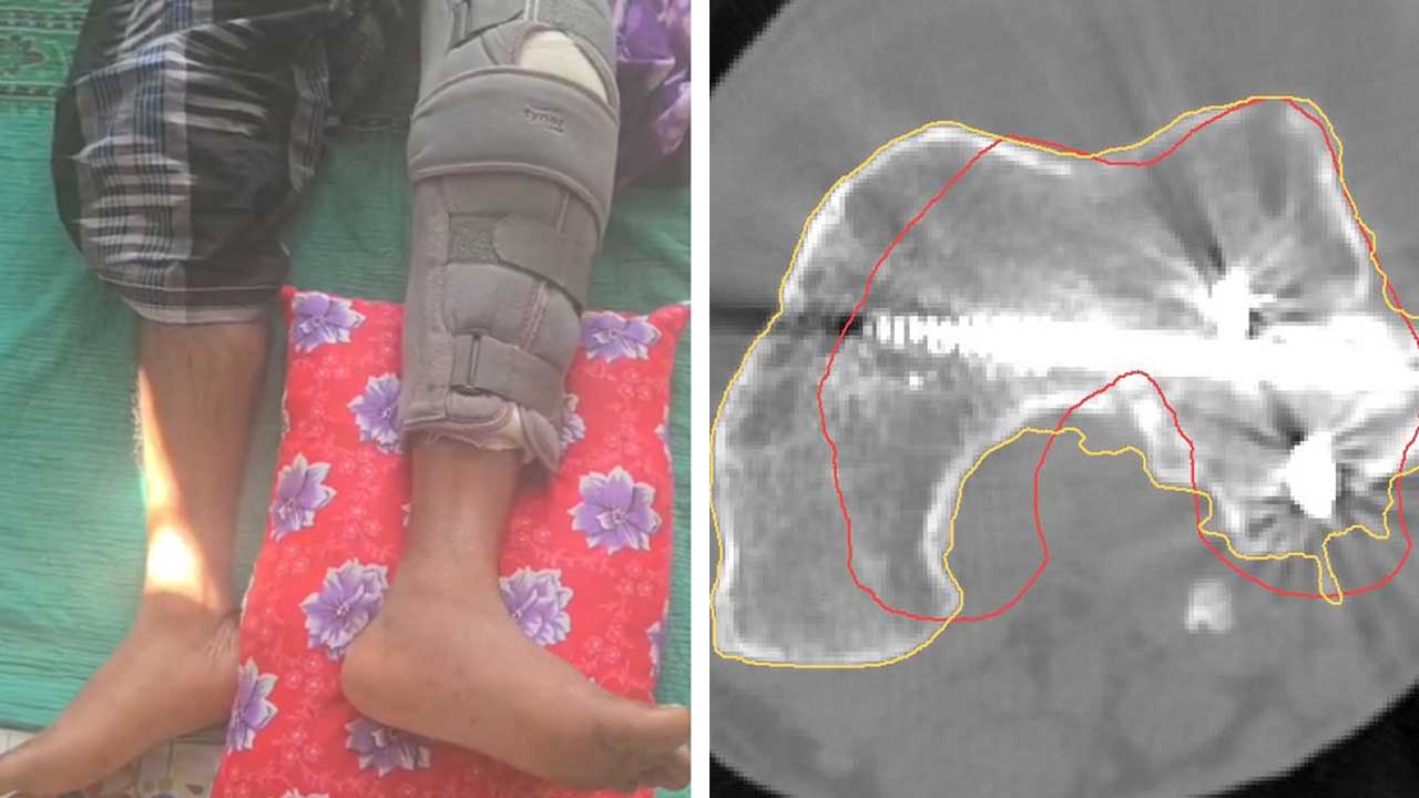 দুর্ঘটনায় আহত যুবকের পায়ে মৃত মানুষের হাড় প্রতিস্থাপন পশ্চিম বাংলায়